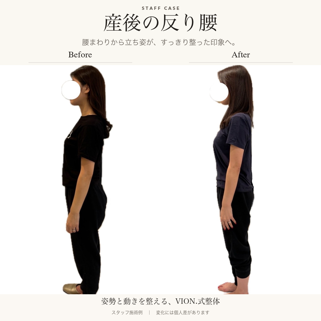 産後の反り腰の施術前後の比較。左が施術前、右が施術後