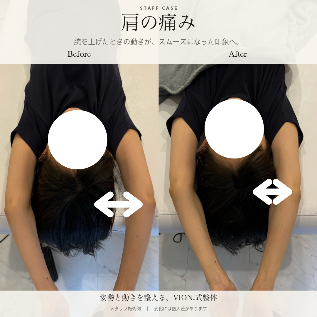 肩の痛みの施術前後の比較。左が施術前、右が施術後