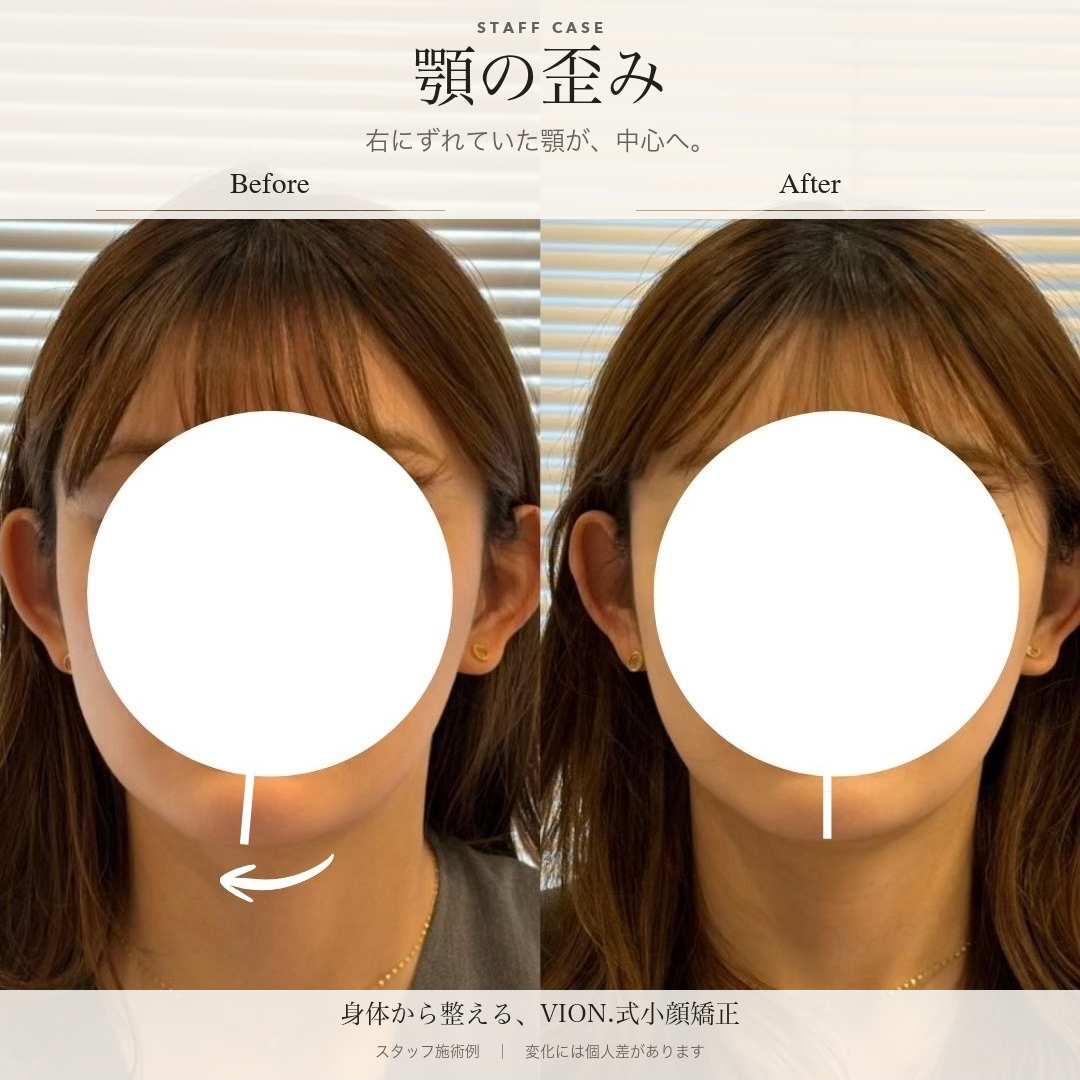 顎の歪みの施術前後の比較。左が施術前、右が施術後