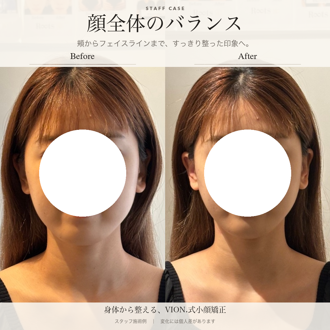 顔全体のバランスの施術前後の比較。左が施術前、右が施術後