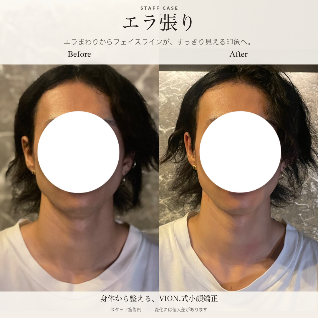エラ張りの施術前後の比較。左が施術前、右が施術後