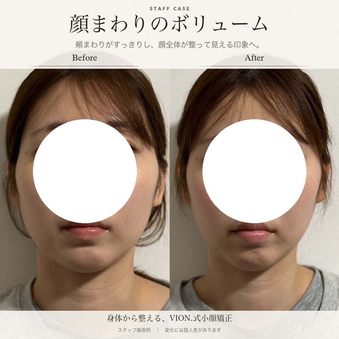 顔まわりのボリュームの施術前後の比較。左が施術前、右が施術後