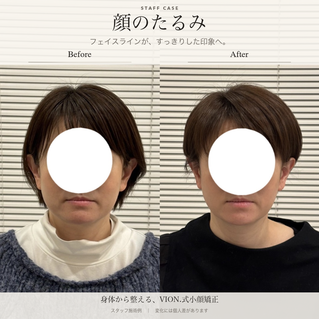 顔のたるみの施術前後の比較。左が施術前、右が施術後